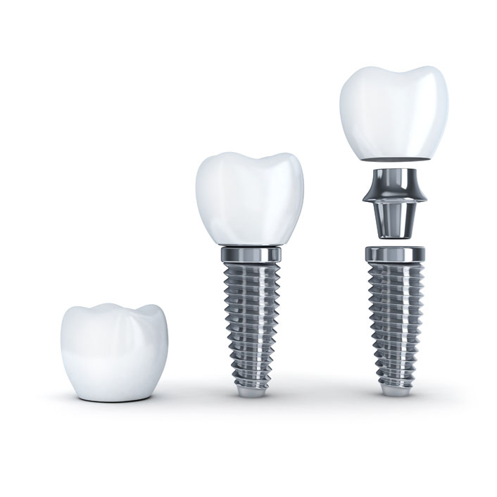 Implants - Dental Services