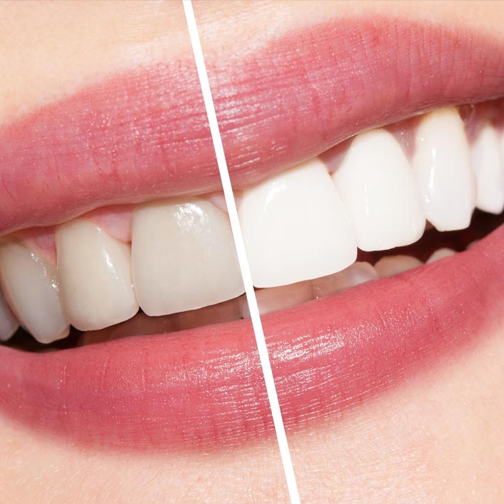 Teeth Whitening - Dental Services